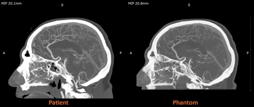 Comparison: clinical vs phantom