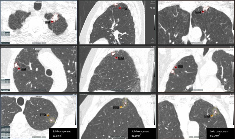 Histologically confirmed lung cancer cases detected at immediate referral after...