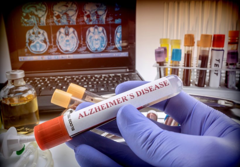 A hand in a blue rubber glove holding a blood test tube labelled Alzheimers...