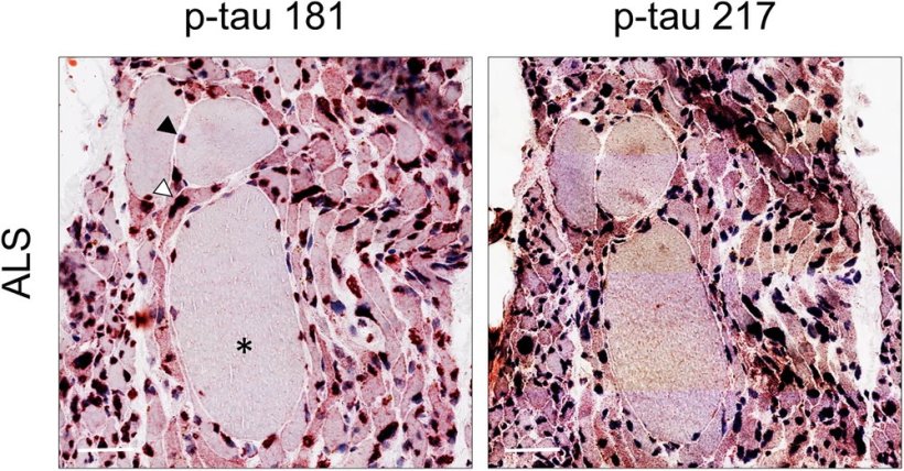 Immunhistochemische Auswertungen zeigen: Auch bei Patienten mit Amyotropher...