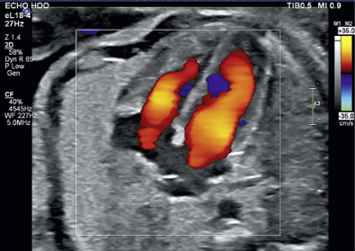 Non-suspicious four-chamber view with colour Doppler showing ventricular...