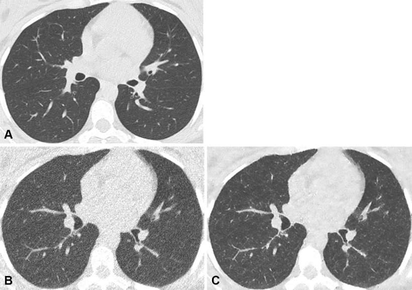 Axial noncontrast chest CT lung window images in a 42-year-old male participant...