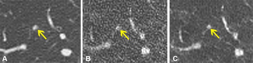 Axial noncontrast chest CT lung window images in a 54-year-old female...