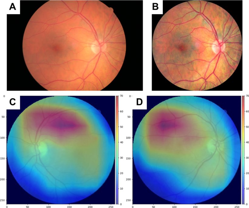 Analyse von Netzhautaufnahmen anhand eines EfficientNet-B2-Netzwerks zur...