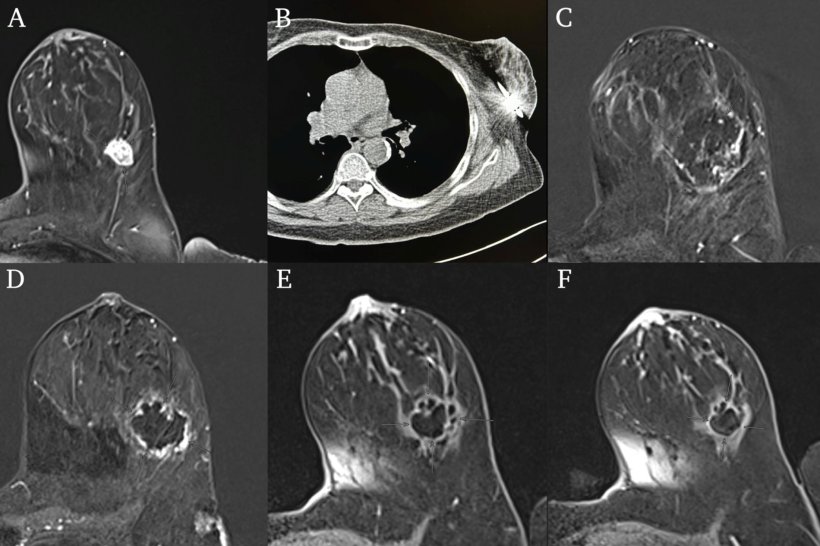 59-year-old female patient with cancer in the left breast. The Cryoablation was...