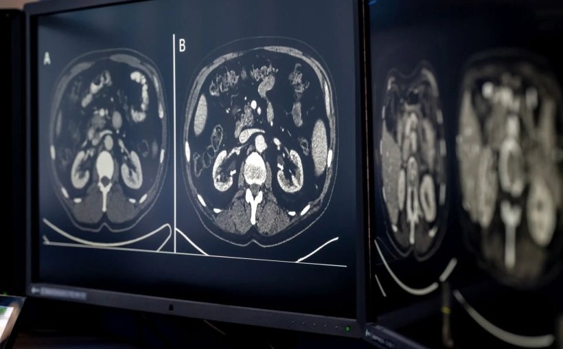 Zwei Computermonitore, auf denen CT-Aufnahmen des Abdomens zu sehen sind