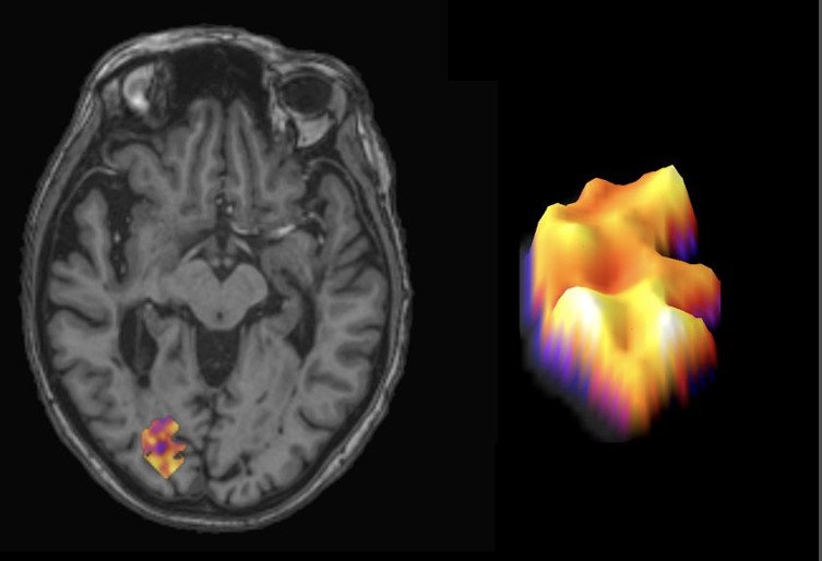 A PET imaging scan of a human brain, with a multiple sclerosis lesion...