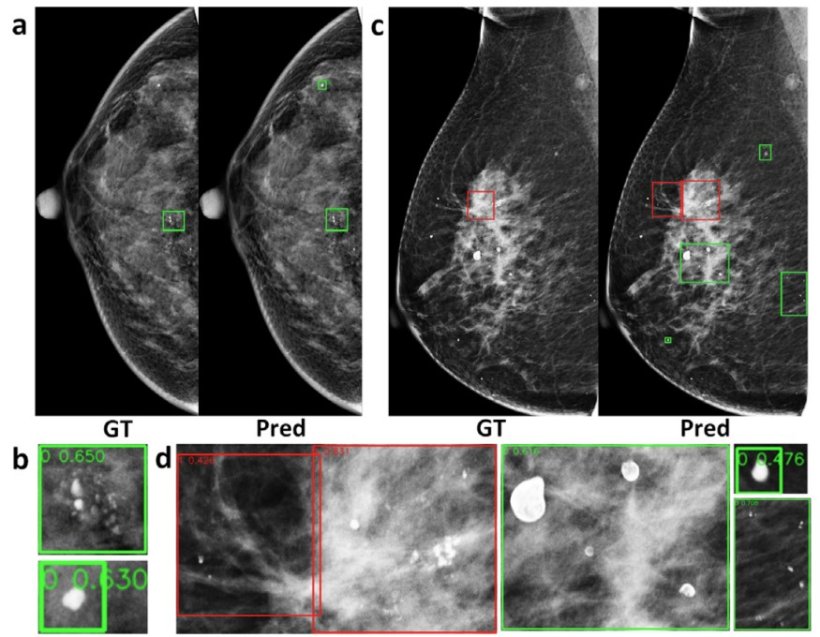 Results of microcalcification detection experiments. (a) A benign example of...