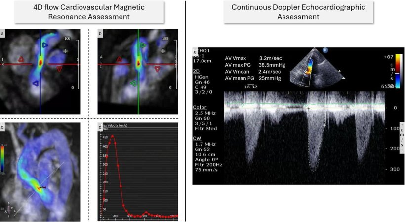 4D flow MRI to quicker diagnose aortic stenosis