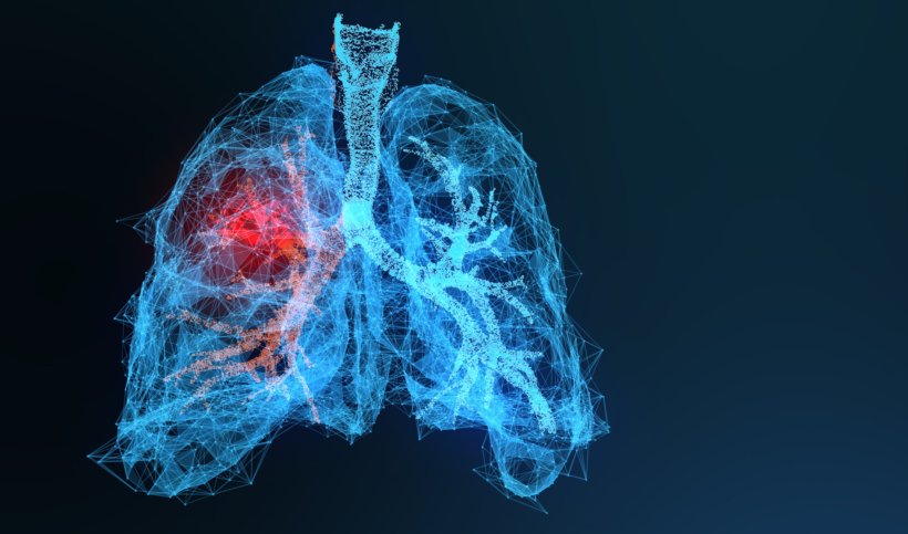 Blue 3D wireframe illustration of human lungs with lung cancer highlighted in...