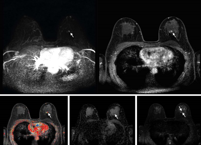 Abbreviated axial MRI images show a 7-mm irregular mass with irregular margin...