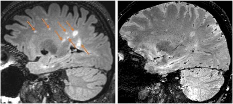 Two MRI scans of a human brain, with orange arrows indicating lesions from...