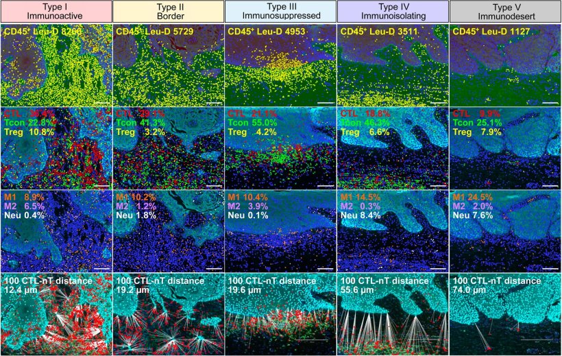 Table with immune profiles of tongue cancer cells, arranged in a 5x5 grid