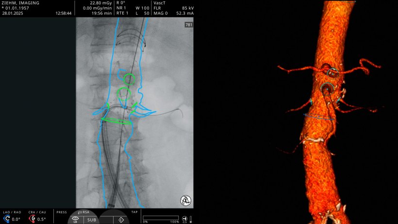 Endovascular Navigation for aorto-iliac procedures on one user interface,...