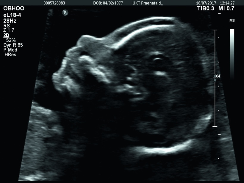 12 week ultrasound down syndrome pictures