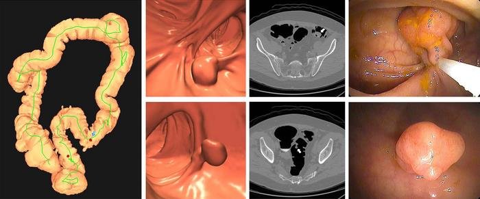 Images of positive CT colonography (CTC) screening examination result in an...