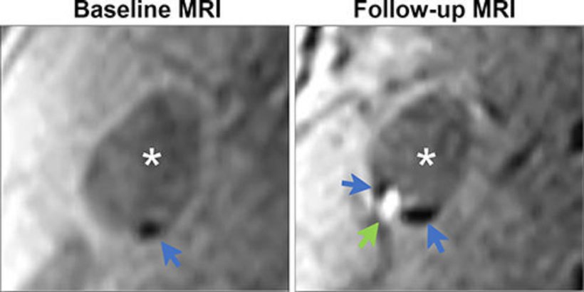 Demonstration of colocalization of pre-existing calcification and incident...