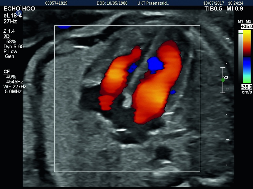 Non-suspicious four-chamber view with colour Doppler showing ventricular...