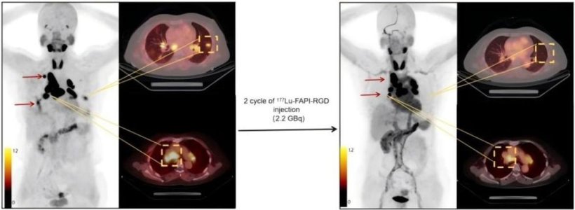 “Smart missile” radiopharmaceutical shows promise against multiple cancers