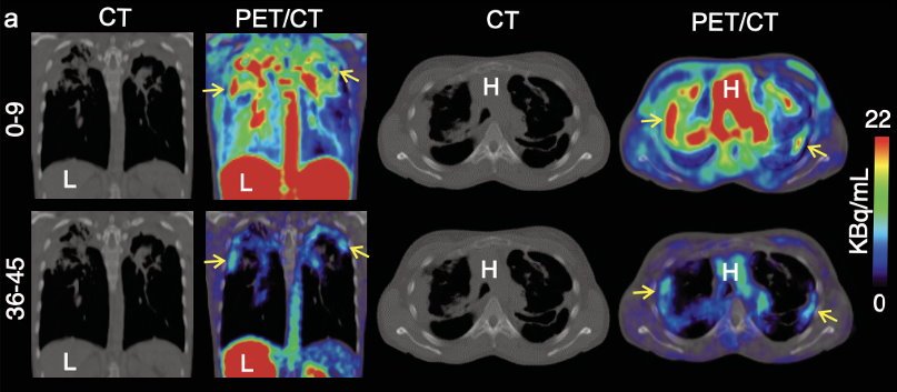 Medical scans of human lungs in CT and PET/CT