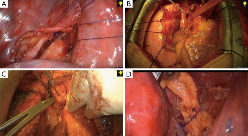Four pictures of airway surgery techniques