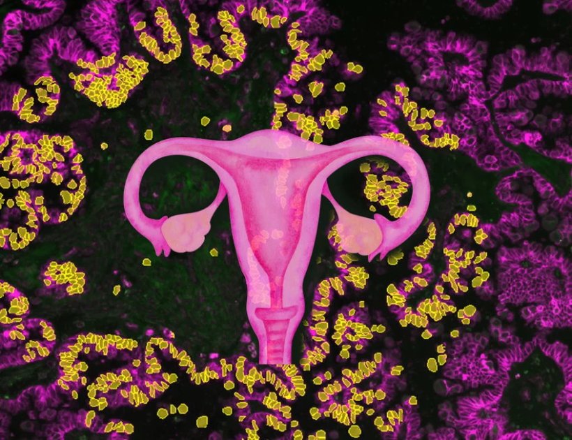 Eine Illustration der Gebärmutter in pink vor einer Mikroskopie von...
