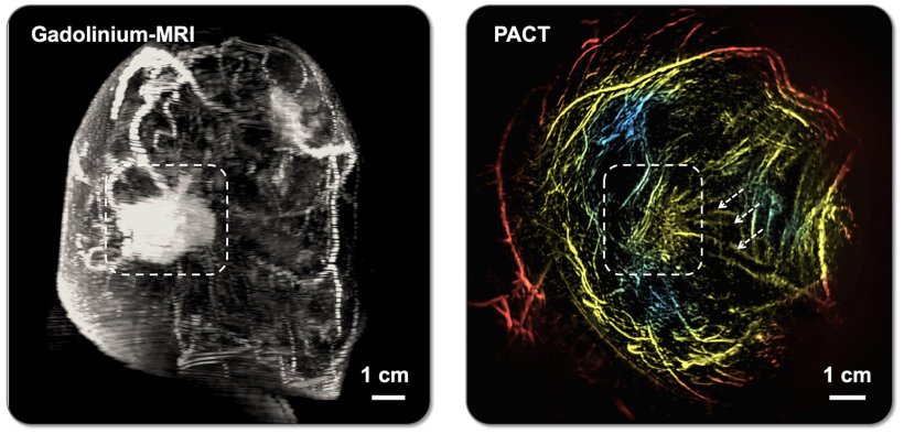 MRI and PACT imaging of a human breast