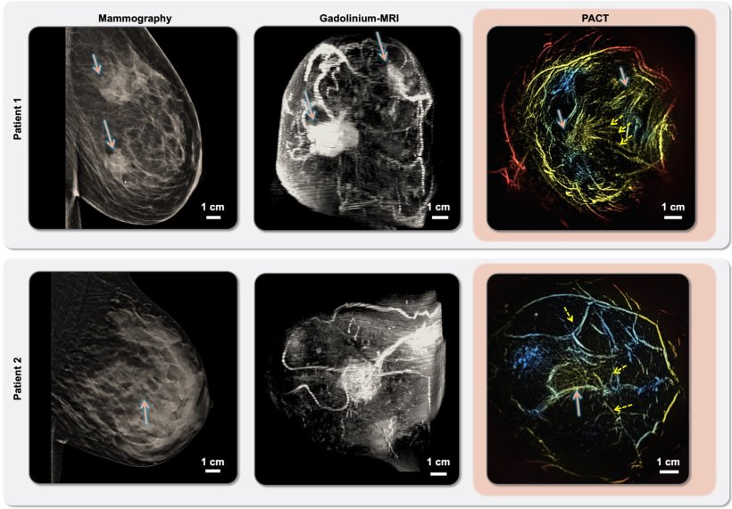 Medical breast imaging from mammography, MRI and PACT, arranged in a 3x2 grid