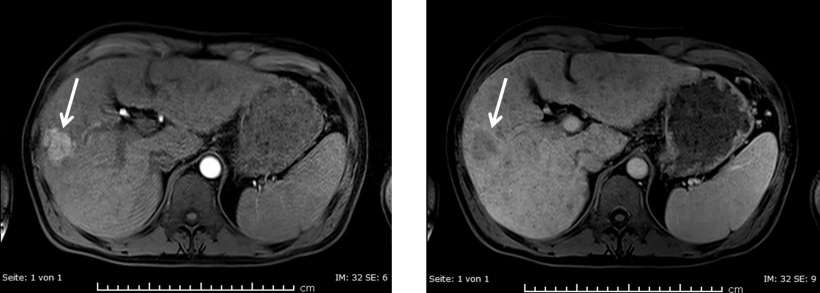MRT eines Patienten mit HCC: Der Tumor zeigt ein typisches...