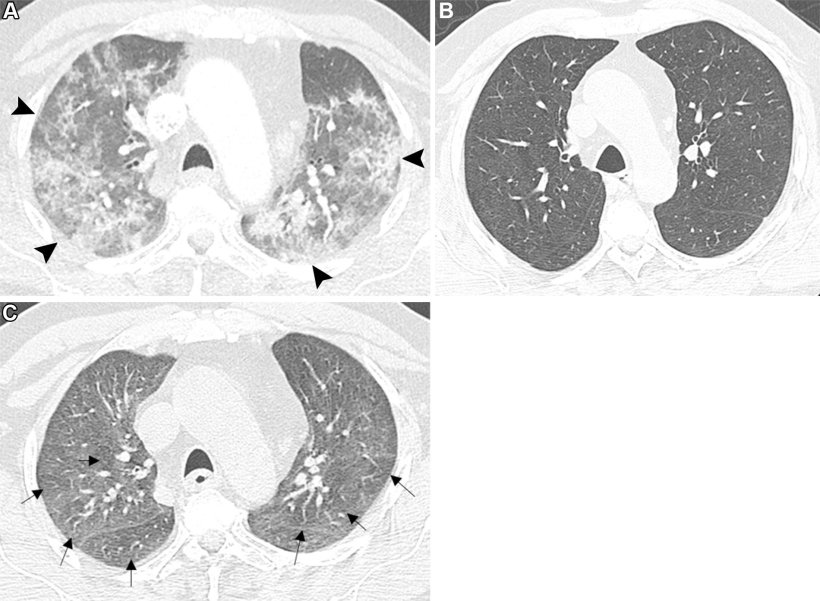Three lung CT scans of a patient after a Covid-19 infection