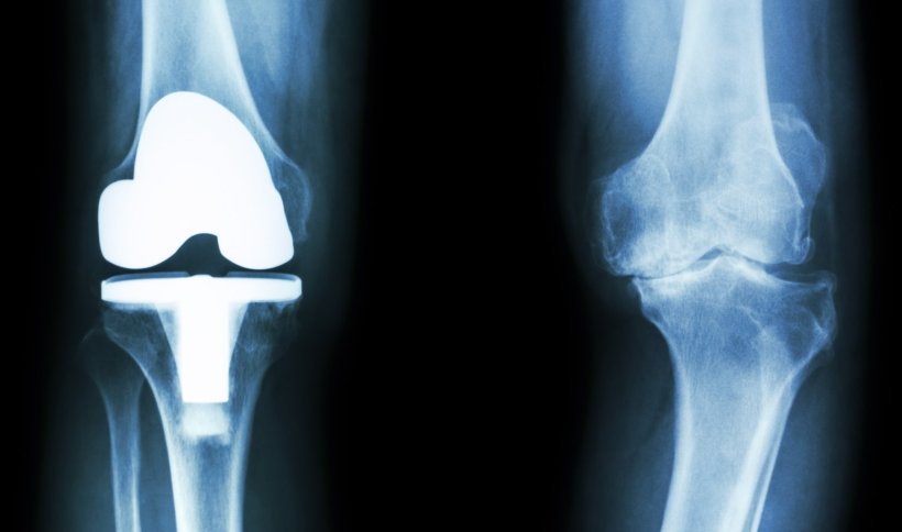 Röntgenbild von zwei Knien, eines mit Implantat, eines ohne