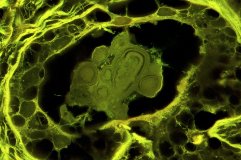 Benign breast disease calcification in green
