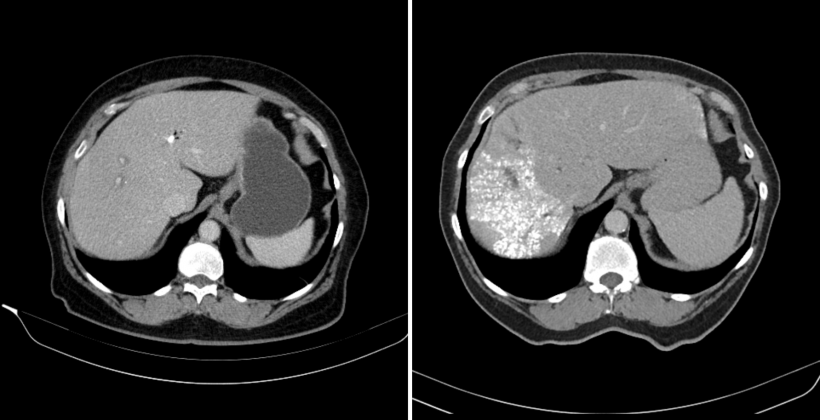 Links: Kontrastverstärkte CT der Leber vor Embolisation der Vena portae rechts...