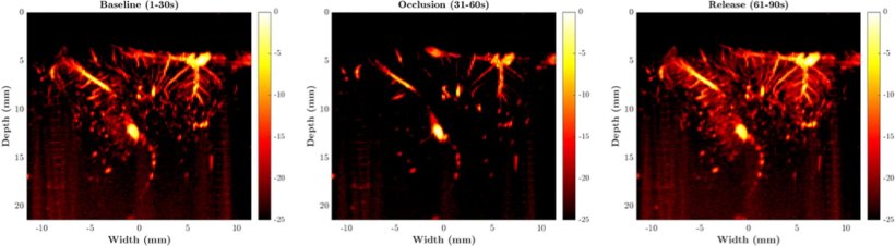 Three ultrasound images of intracranial blood flow