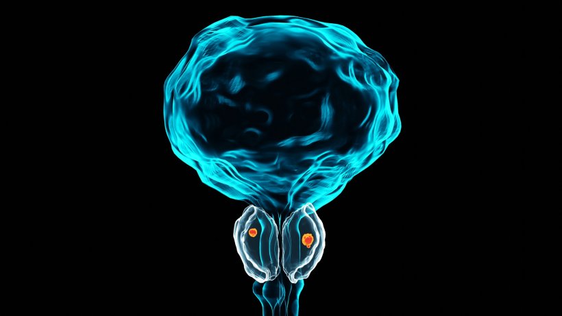 3D illustration of prostate with prostate cancer marked in red