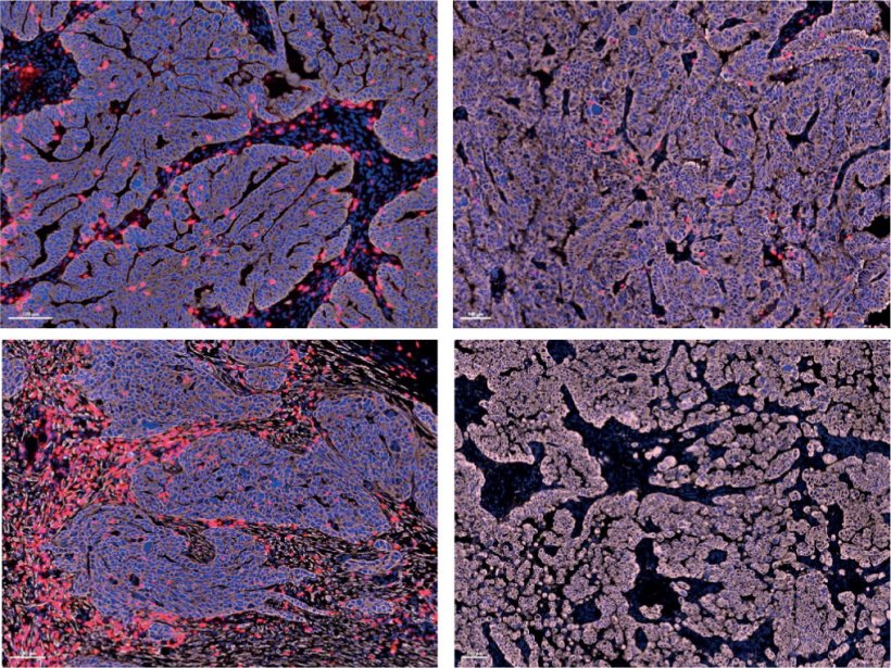 Four samples of ovarian cancer, arranged in a 2x2 grid