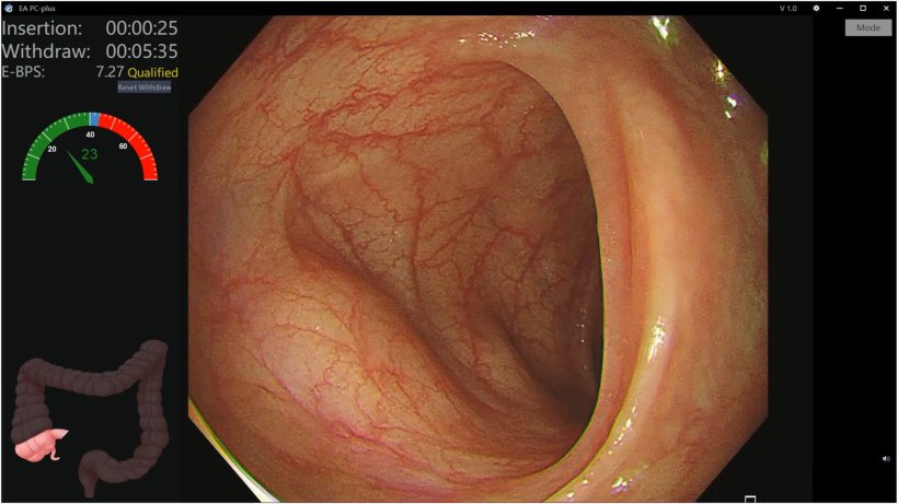 Endoscopy image taken during a colonoscopy, with a computer-generated risk...