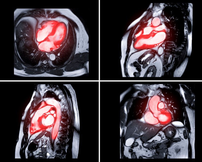 Four MRI scans of a human thorax arranged in a 2x2 grid, with the heart...