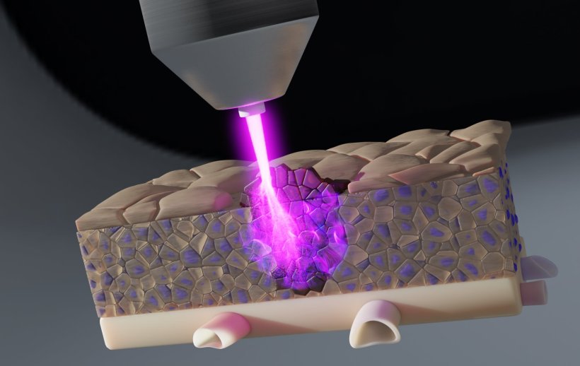 3D-Illustration eines lilafarbenen Plasmastrahls, der in einen Gewebeschnitt...