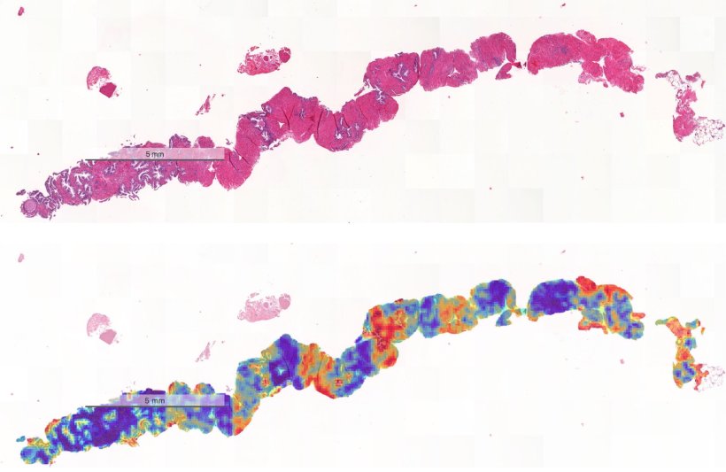 The image shows an original biopsy (top) and a colour-coded biopsy (bottom)....