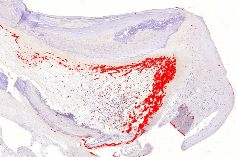 A pathology tissue sample in light purple hues, with a distinctive red V-shaped...