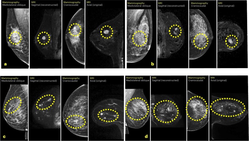 Sixteen breast MRI scans, arranged in two rows. Each image has a yellow dashed...