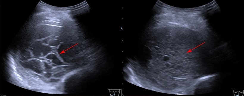 Illustration of multiple septations in a pleural effusion on ultrasound
