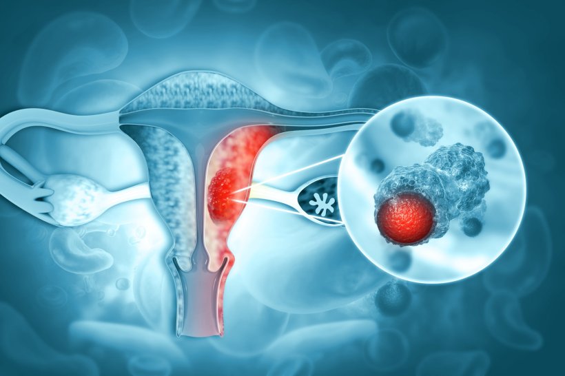 Medical illustration of endometrial cancer in a womans uterus