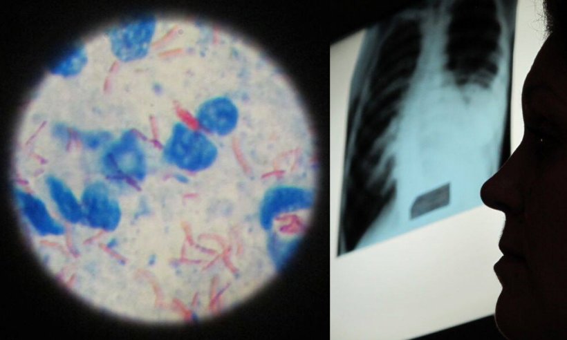 Links: Tuberkulose-Erreger unter dem Mikroskop; Rechts: Die Silhouette eines...