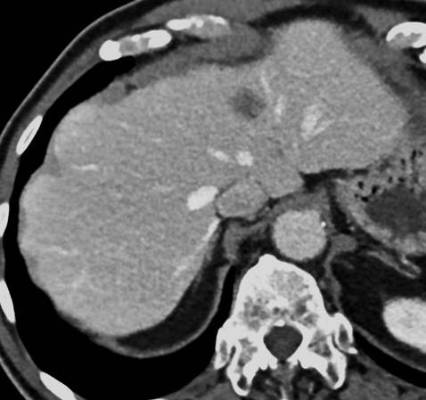 CECT scan of an 81 year old with a hypodense lesion in the 4th segment of the...