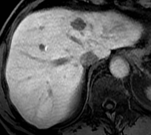 Delayed MR imaging after IV administration of gadoxetic acid