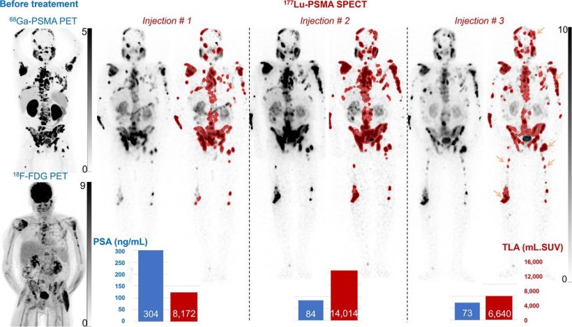 Prostate cancer: High-speed whole-body SPECT tracks tumor evolution