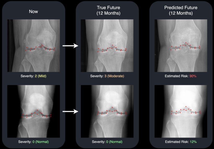AI predicts future X-rays of osteoarthritis patients