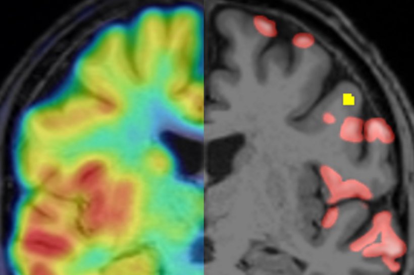PET-Bild des Gehirns eines Patienten mit Multipler Sklerose (MS)